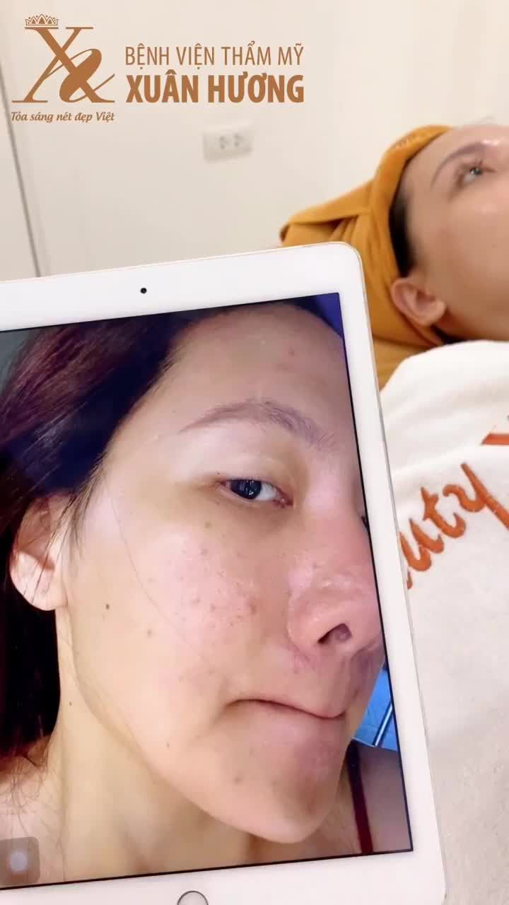 DA SÁNG MỊN, HẾT THÂM SAU 3 BUỔI ĐIỀU TRỊ TRẺ HOÁ DA BABY FACE